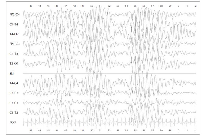 EEG Angelman